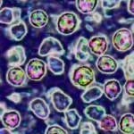 Tragedy in Pennsylvania: Measles Outbreak Claims Another Life, Sparking Urgent Public Health Warnings